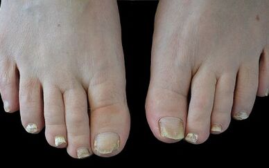 Come sbarazzarsi del fungo sulle dita