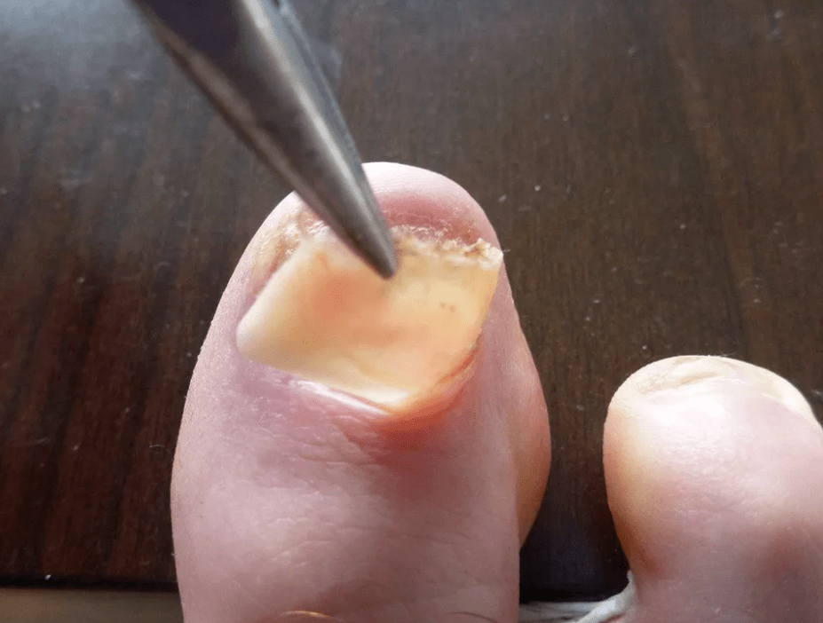 Distanza della piastra