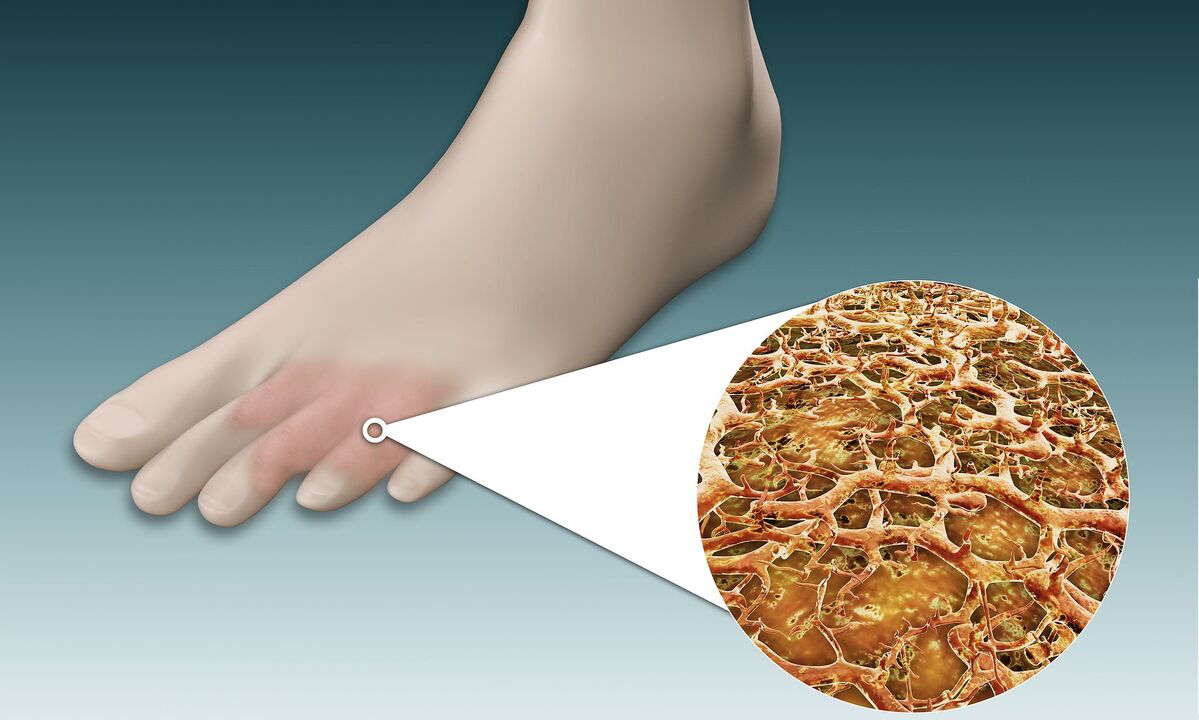 spore di funghi del piede